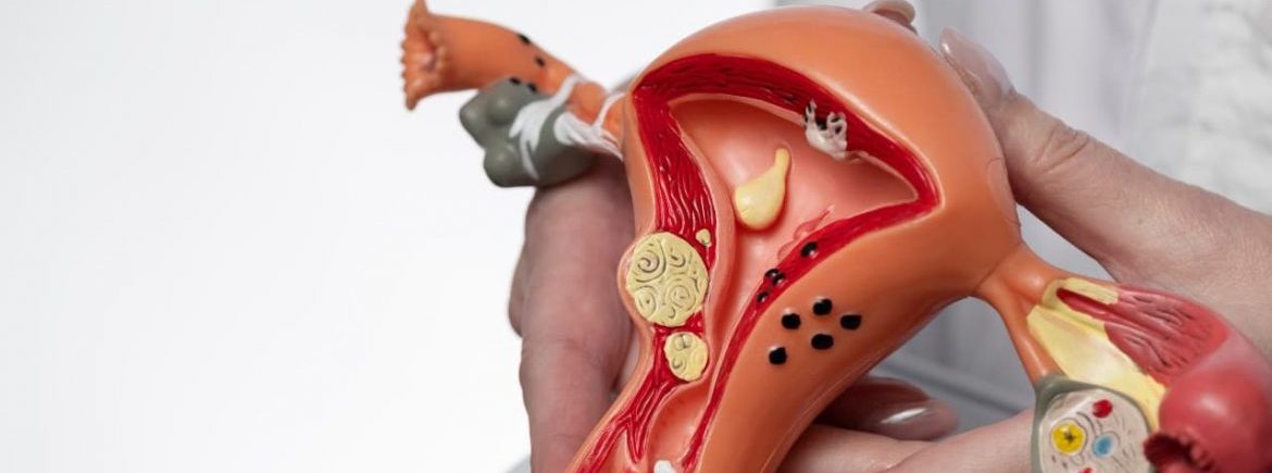 Jemperli® (dostarlimabe) é aprovado pela Anvisa para tratar câncer de endométrio